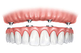 all on 4 implants frisco tx