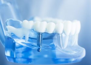 best dental implants frisco tx