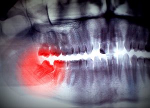 wisdom tooth removal frisco