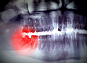 wisdom tooth removal frisco