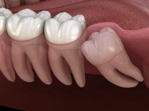 wisdom teeth frisco