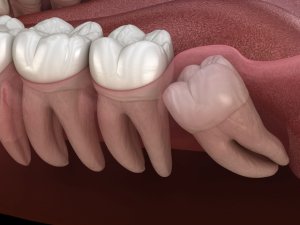 wisdom teeth frisco
