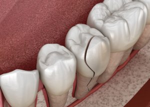 fractured teeth surgery repair frisco tx