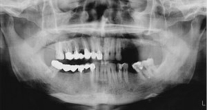 upper and lower jaw fracture frisco texas