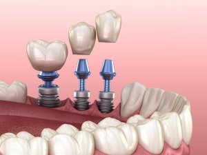 3D illustration of a dental procedure showing immediate dental implants being placed in the lower jaw, with crowns being attached to the implants.