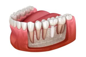 3D illustration of a dental implant procedure showing a cross-section of the lower jaw with a dental implant placed among natural teeth