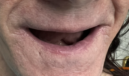 Smile Reconstruction Before