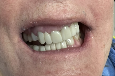 Full Arch Implant Case Before