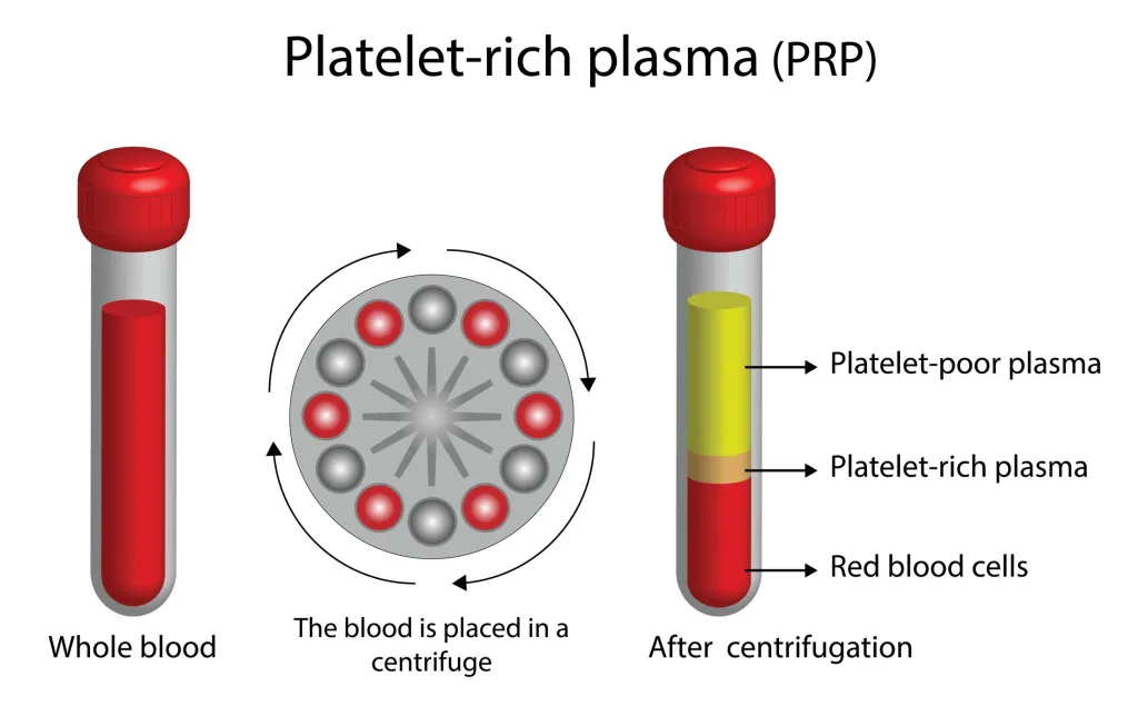 Platelet Rich Fibrin | PRF Treatment | Frisco, Plano, & Prosper