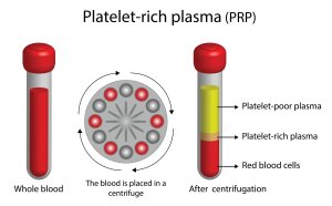 image of platelet rich fibrin