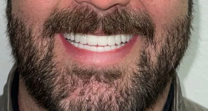 Full Smile After