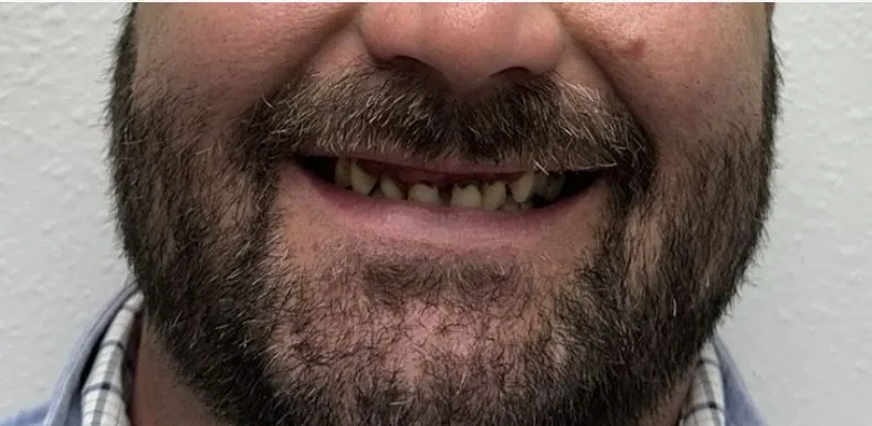 Full Smile Before
