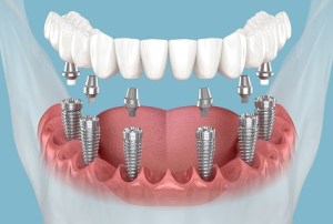 Implant Dentures