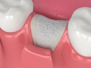 example of ridge augmentation